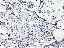 NLN / Neurolysin Antibody - IHC of paraffin-embedded Adenocarcinoma of Human colon tissue using anti-NLN mouse monoclonal antibody.