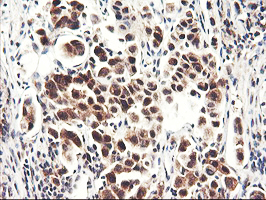 NLN / Neurolysin Antibody - IHC of paraffin-embedded Carcinoma of Human lung tissue using anti-NLN mouse monoclonal antibody.