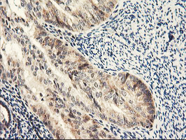 NLN / Neurolysin Antibody - IHC of paraffin-embedded Adenocarcinoma of Human endometrium tissue using anti-NLN mouse monoclonal antibody.