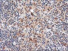 NLN / Neurolysin Antibody - IHC of paraffin-embedded Human lymphoma tissue using anti-NLN mouse monoclonal antibody.