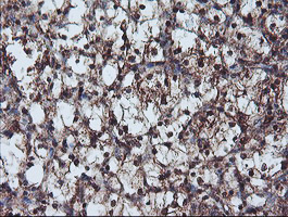 NLN / Neurolysin Antibody - IHC of paraffin-embedded Carcinoma of Human kidney tissue using anti-NLN mouse monoclonal antibody. (Heat-induced epitope retrieval by 10mM citric buffer, pH6.0, 100C for 10min).