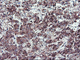 NLN / Neurolysin Antibody - IHC of paraffin-embedded Carcinoma of Human liver tissue using anti-NLN mouse monoclonal antibody. (Heat-induced epitope retrieval by 10mM citric buffer, pH6.0, 100C for 10min).