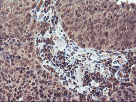 NLN / Neurolysin Antibody - IHC of paraffin-embedded Carcinoma of Human bladder tissue using anti-NLN mouse monoclonal antibody. (Heat-induced epitope retrieval by 10mM citric buffer, pH6.0, 100C for 10min).