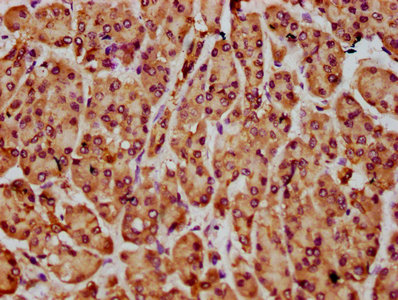 NLN / Neurolysin Antibody - Immunohistochemistry Dilution at 1:300 and staining in paraffin-embedded human pancreatic cancer performed on a Leica BondTM system. After dewaxing and hydration, antigen retrieval was mediated by high pressure in a citrate buffer (pH 6.0). Section was blocked with 10% normal Goat serum 30min at RT. Then primary antibody (1% BSA) was incubated at 4°C overnight. The primary is detected by a biotinylated Secondary antibody and visualized using an HRP conjugated SP system.
