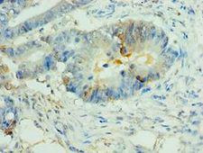 NLRP2 / NALP2 Antibody - Immunohistochemistry of paraffin-embedded human colon cancer using antibody at 1:100 dilution.