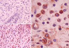 NLRP2 / NALP2 Antibody - IHC of NALP2 in formalin-fixed, paraffin-embedded human colon tumor tissue using an isotype control (top left) and Polyclonal Antibody to NALP2 (bottom left, right) at 5 ug/ml.