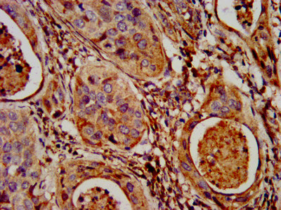 NLRP7 / NALP7 Antibody - Immunohistochemistry image at a dilution of 1:300 and staining in paraffin-embedded human cervical cancer performed on a Leica BondTM system. After dewaxing and hydration, antigen retrieval was mediated by high pressure in a citrate buffer (pH 6.0) . Section was blocked with 10% normal goat serum 30min at RT. Then primary antibody (1% BSA) was incubated at 4 °C overnight. The primary is detected by a biotinylated secondary antibody and visualized using an HRP conjugated SP system.
