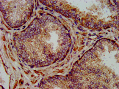 NLRP7 / NALP7 Antibody - Immunohistochemistry image at a dilution of 1:300 and staining in paraffin-embedded human prostate cancer performed on a Leica BondTM system. After dewaxing and hydration, antigen retrieval was mediated by high pressure in a citrate buffer (pH 6.0) . Section was blocked with 10% normal goat serum 30min at RT. Then primary antibody (1% BSA) was incubated at 4 °C overnight. The primary is detected by a biotinylated secondary antibody and visualized using an HRP conjugated SP system.