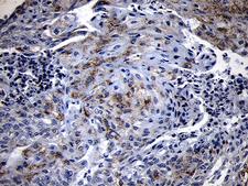 NLRX1 Antibody - Immunohistochemical staining of paraffin-embedded Adenocarcinoma of Human endometrium tissue using anti-NLRX1 mouse monoclonal antibody. (Heat-induced epitope retrieval by 1mM EDTA in 10mM Tris buffer. (pH8.5) at 120°C for 3 min. (1:150)