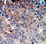 NME1 / NM23 Antibody - Formalin-fixed and paraffin-embedded human cancer tissue reacted with the primary antibody, which was peroxidase-conjugated to the secondary antibody, followed by DAB staining. This data demonstrates the use of this antibody for immunohistochemistry; clinical relevance has not been evaluated. BC = breast carcinoma; HC = hepatocarcinoma.