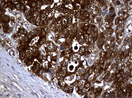 NME1 / NM23 Antibody - IHC of paraffin-embedded Adenocarcinoma of Human colon tissue using anti-NME1 mouse monoclonal antibody.