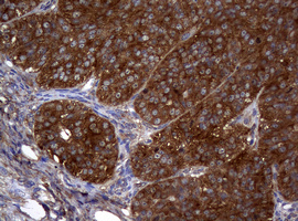 NME1 / NM23 Antibody - IHC of paraffin-embedded Adenocarcinoma of Human ovary tissue using anti-NME1 mouse monoclonal antibody.