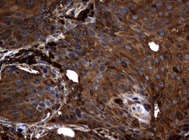 NME1 / NM23 Antibody - IHC of paraffin-embedded Carcinoma of Human lung tissue using anti-NME1 mouse monoclonal antibody.