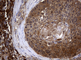 NME1 / NM23 Antibody - IHC of paraffin-embedded Carcinoma of Human lung tissue using anti-NME1 mouse monoclonal antibody.