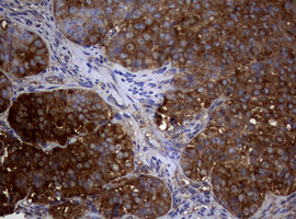 NME1 / NM23 Antibody - IHC of paraffin-embedded Adenocarcinoma of Human ovary tissue using anti-NME1 mouse monoclonal antibody.