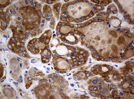 NME1 / NM23 Antibody - IHC of paraffin-embedded Carcinoma of Human thyroid tissue using anti-NME1 mouse monoclonal antibody.