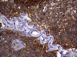 NME1 / NM23 Antibody - IHC of paraffin-embedded Adenocarcinoma of Human endometrium tissue using anti-NME1 mouse monoclonal antibody.