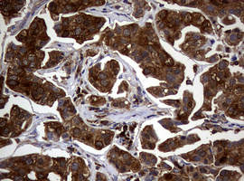 NME1 / NM23 Antibody - IHC of paraffin-embedded Carcinoma of Human bladder tissue using anti-NME1 mouse monoclonal antibody.