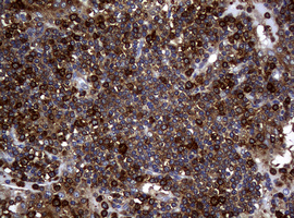 NME1 / NM23 Antibody - IHC of paraffin-embedded Human lymphoma tissue using anti-NME1 mouse monoclonal antibody.