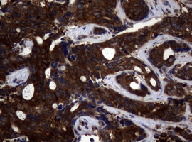 NME1 / NM23 Antibody - IHC of paraffin-embedded Adenocarcinoma of Human breast tissue using anti-NME1 mouse monoclonal antibody.