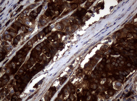 NME1 / NM23 Antibody - IHC of paraffin-embedded Adenocarcinoma of Human colon tissue using anti-NME1 mouse monoclonal antibody.