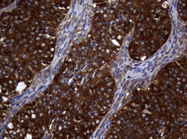 NME1 / NM23 Antibody - IHC of paraffin-embedded Adenocarcinoma of Human ovary tissue using anti-NME1 mouse monoclonal antibody.