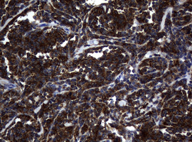NME1 / NM23 Antibody - IHC of paraffin-embedded Human lymphoma tissue using anti-NME1 mouse monoclonal antibody.