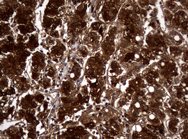 NME1 / NM23 Antibody - IHC of paraffin-embedded Carcinoma of Human liver tissue using anti-NME1 mouse monoclonal antibody.