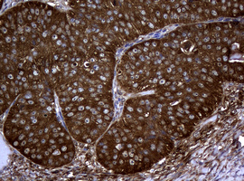 NME1 / NM23 Antibody - IHC of paraffin-embedded Adenocarcinoma of Human ovary tissue using anti-NME1 mouse monoclonal antibody.