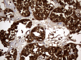 NME1 / NM23 Antibody - IHC of paraffin-embedded Carcinoma of Human pancreas tissue using anti-NME1 mouse monoclonal antibody.