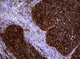 NME1 / NM23 Antibody - IHC of paraffin-embedded Adenocarcinoma of Human endometrium tissue using anti-NME1 mouse monoclonal antibody.