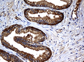 NME1 / NM23 Antibody - IHC of paraffin-embedded Carcinoma of Human prostate tissue using anti-NME1 mouse monoclonal antibody.