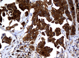 NME1 / NM23 Antibody - IHC of paraffin-embedded Carcinoma of Human bladder tissue using anti-NME1 mouse monoclonal antibody.