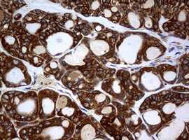 NME1 / NM23 Antibody - IHC of paraffin-embedded Carcinoma of Human thyroid tissue using anti-NME1 mouse monoclonal antibody.