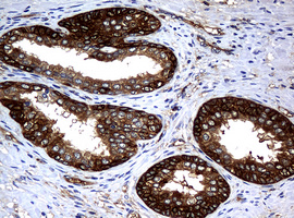 NME1 / NM23 Antibody - IHC of paraffin-embedded Carcinoma of Human prostate tissue using anti-NME1 mouse monoclonal antibody.