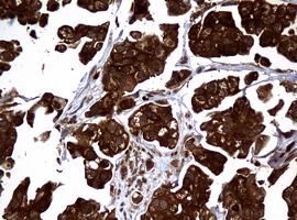NME1 / NM23 Antibody - IHC of paraffin-embedded Carcinoma of Human bladder tissue using anti-NME1 mouse monoclonal antibody.