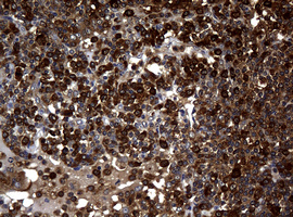 NME1 / NM23 Antibody - IHC of paraffin-embedded Human lymphoma tissue using anti-NME1 mouse monoclonal antibody.