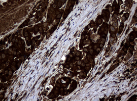 NME1 / NM23 Antibody - IHC of paraffin-embedded Adenocarcinoma of Human colon tissue using anti-NME1 mouse monoclonal antibody.