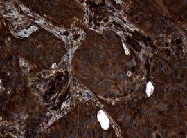 NME1 / NM23 Antibody - IHC of paraffin-embedded Carcinoma of Human lung tissue using anti-NME1 mouse monoclonal antibody.