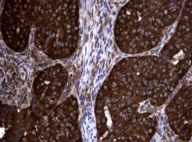 NME1 / NM23 Antibody - IHC of paraffin-embedded Adenocarcinoma of Human ovary tissue using anti-NME1 mouse monoclonal antibody.