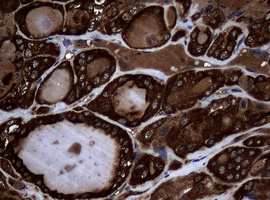 NME1 / NM23 Antibody - IHC of paraffin-embedded Carcinoma of Human thyroid tissue using anti-NME1 mouse monoclonal antibody.