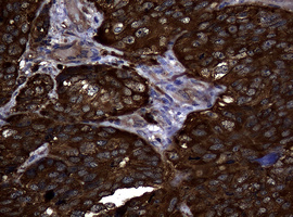 NME1 / NM23 Antibody - IHC of paraffin-embedded Adenocarcinoma of Human endometrium tissue using anti-NME1 mouse monoclonal antibody.