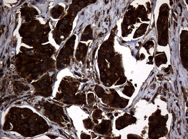 NME1 / NM23 Antibody - IHC of paraffin-embedded Carcinoma of Human bladder tissue using anti-NME1 mouse monoclonal antibody.