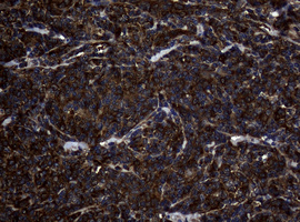 NME1 / NM23 Antibody - IHC of paraffin-embedded Human lymphoma tissue using anti-NME1 mouse monoclonal antibody.