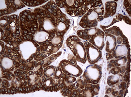 NME1 / NM23 Antibody - IHC of paraffin-embedded Carcinoma of Human thyroid tissue using anti-NME1 mouse monoclonal antibody.