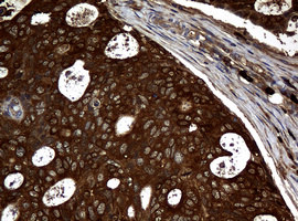 NME1 / NM23 Antibody - IHC of paraffin-embedded Adenocarcinoma of Human breast tissue using anti-NME1 mouse monoclonal antibody.