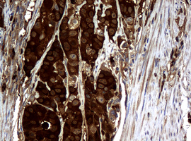 NME1 / NM23 Antibody - IHC of paraffin-embedded Adenocarcinoma of Human colon tissue using anti-NME1 mouse monoclonal antibody.