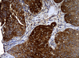 NME1 / NM23 Antibody - IHC of paraffin-embedded Adenocarcinoma of Human ovary tissue using anti-NME1 mouse monoclonal antibody.