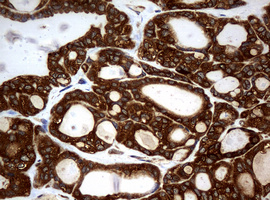 NME1 / NM23 Antibody - IHC of paraffin-embedded Carcinoma of Human thyroid tissue using anti-NME1 mouse monoclonal antibody.