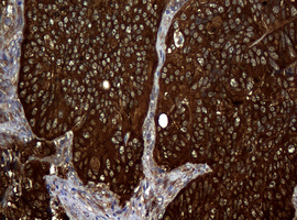 NME1 / NM23 Antibody - IHC of paraffin-embedded Adenocarcinoma of Human endometrium tissue using anti-NME1 mouse monoclonal antibody.